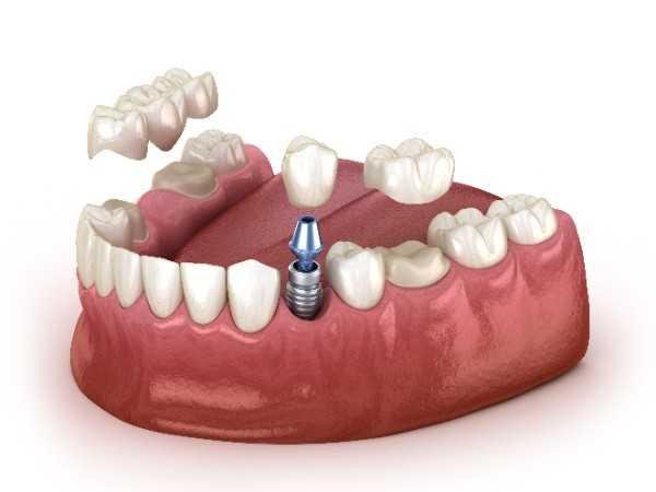 Dental implants Basildon